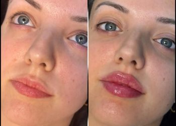 Understanding Fillers Treatment in Dubai for a Non-Surgical Facelift