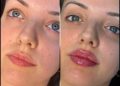 fillers in Dubai