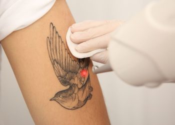 How to Choose the Right Provider for Laser Tattoo Removal in Altamonte Springs.