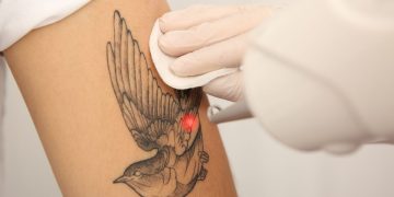 How to Choose the Right Provider for Laser Tattoo Removal in Altamonte Springs.