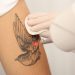 How to Choose the Right Provider for Laser Tattoo Removal in Altamonte Springs.