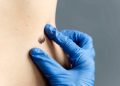 Why Regular Skin And Mole Checks Are Essential For Early Detection