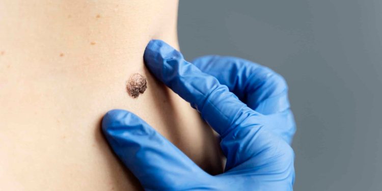 Why Regular Skin And Mole Checks Are Essential For Early Detection
